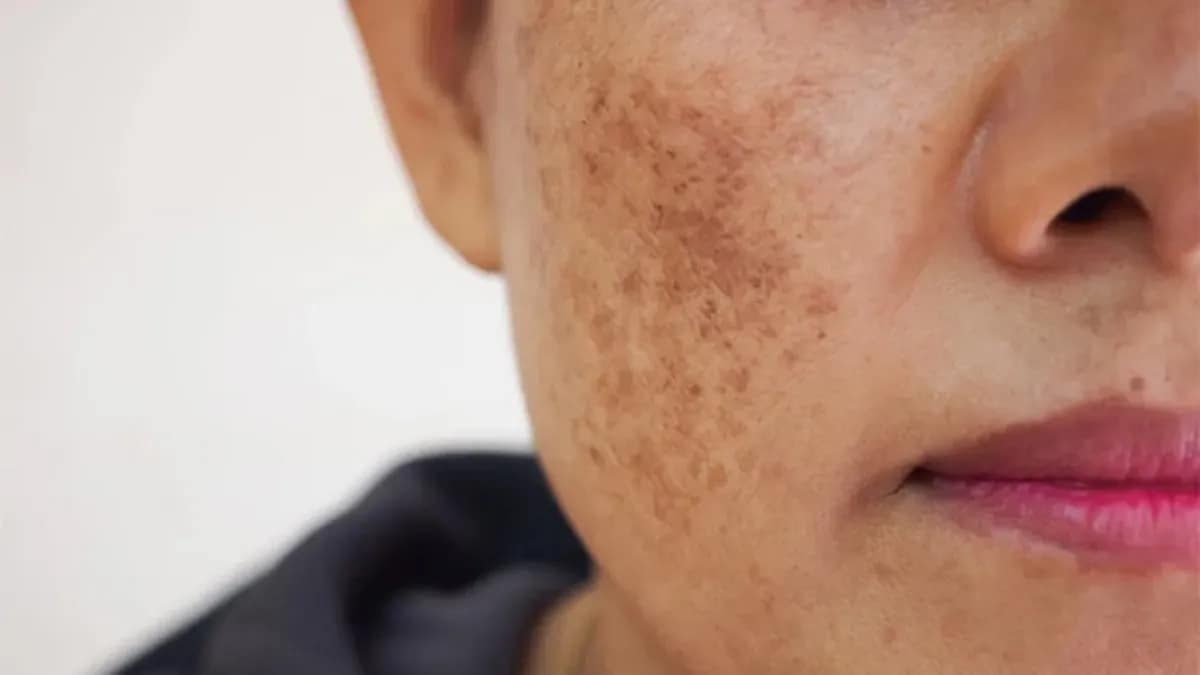 मेलाज्मा: चेहरे के दाग-धब्बों और झाइयों का कारण 42 मेलाज्मा: चेहरे के दाग-धब्बों और झाइयों का कारण December 23, 2025