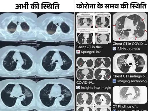 MP में कोरोना वायरस जैसा संक्रमण, स्ट्रेन में बदलाव,4 दिन के बुखार में लंग्स में 40% इन्फेक्शन, दो सीटी स्कैन इमेज से समझें कोराना और वर्तमान स्थिति 42 MP में कोरोना वायरस जैसा संक्रमण, स्ट्रेन में बदलाव,4 दिन के बुखार में लंग्स में 40% इन्फेक्शन, दो सीटी स्कैन इमेज से समझें कोराना और वर्तमान स्थिति November 23, 2025