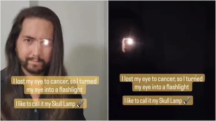 कैंसर से हारने के बाद इस आदमी ने अपनी आंख को टॉर्च में बदल दिया 42 कैंसर से हारने के बाद इस आदमी ने अपनी आंख को टॉर्च में बदल दिया March 5, 2026