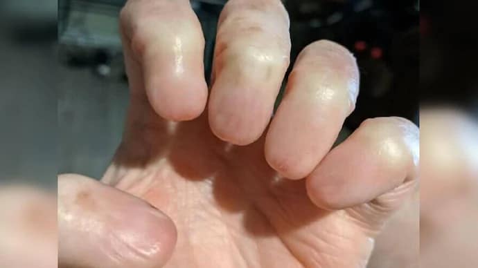 लापता नाखूनों के साथ एक व्यक्ति के हाथ की तस्वीर वायरल हो गई.. 42 लापता नाखूनों के साथ एक व्यक्ति के हाथ की तस्वीर वायरल हो गई.. March 5, 2026